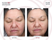 AHA Face Peel